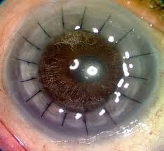 corneal-transplant.jpg?strip=all&lossy=1&ssl=1