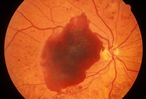 diabetic retinopathy