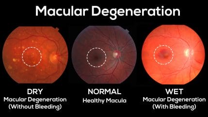 Macular Degeneration - Goodrich Optical