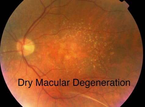 dry_macular_degeneration.jpg?strip=all&lossy=1&ssl=1