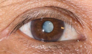 Cataracts - Goodrich Optical