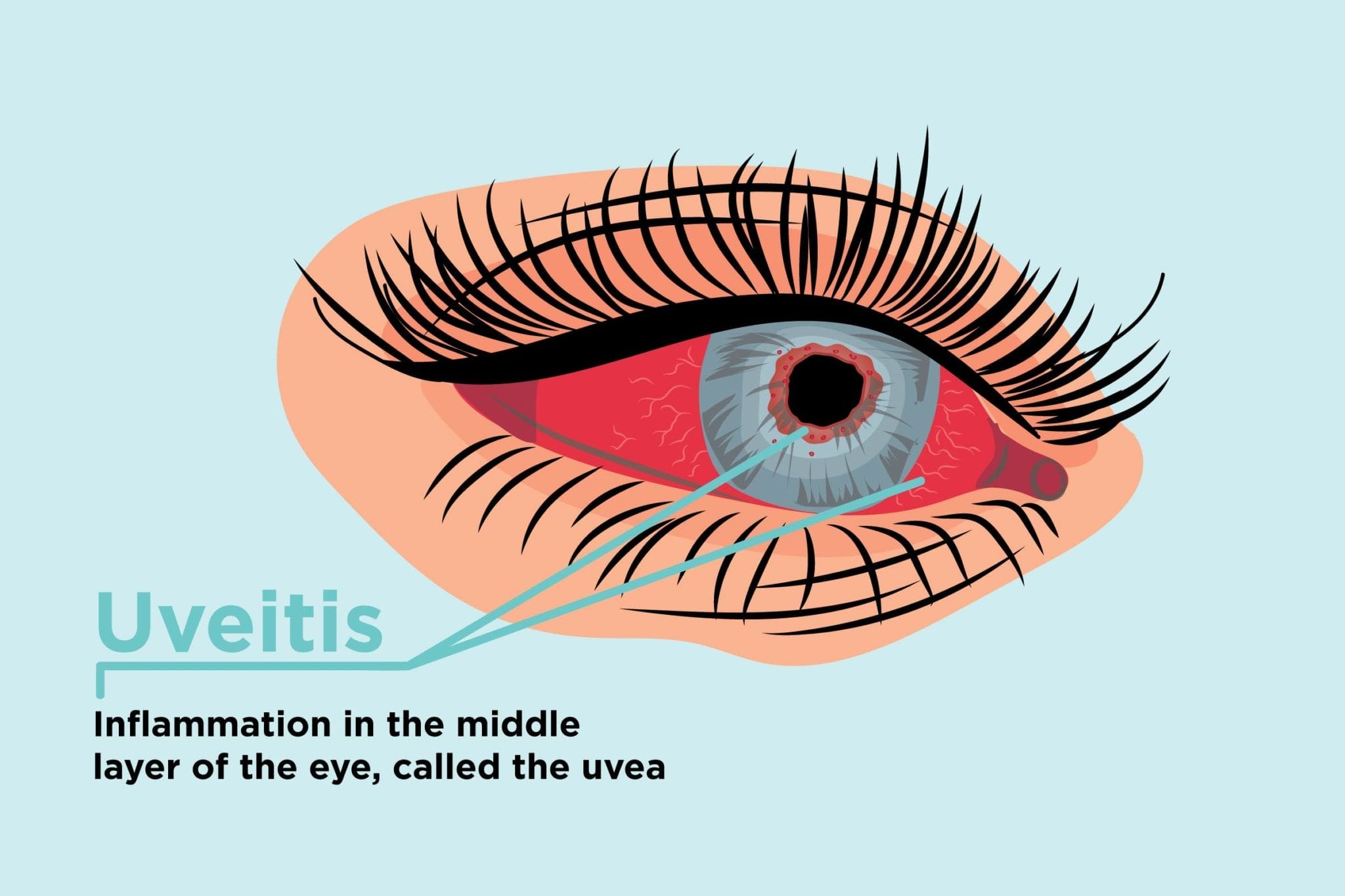 A new Diagnostic method for Posterior Uveitis has been discovered