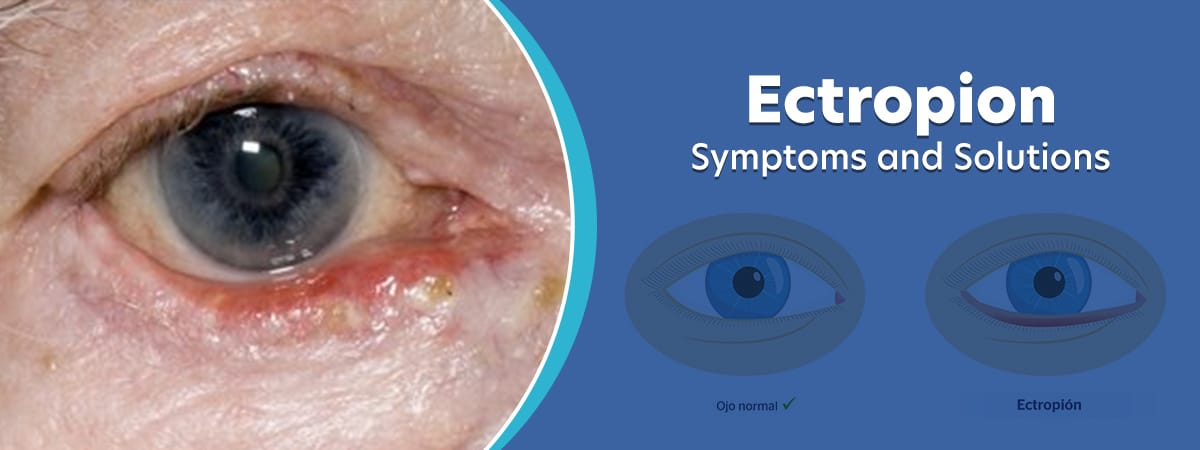 Ectropion.jpg?strip=all&lossy=1&ssl=1